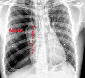 ΠΡΩΤΟΠΑΘΗΣ  ΑΥΤΟΜΑΤΟΣ  ΠΝΕΥΜΟΘΩΡΑΚΑΣ